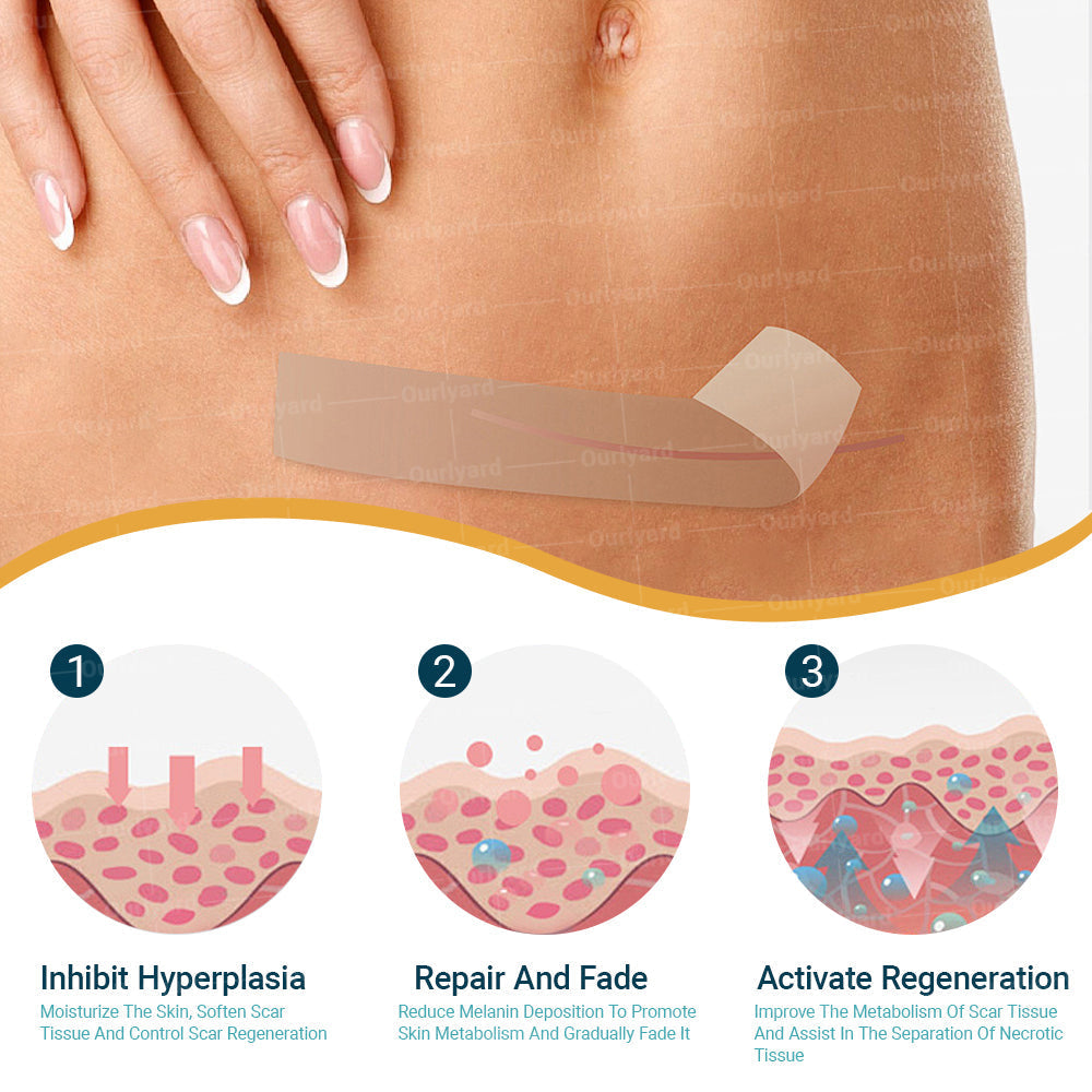 🍉Official Store |Ourlyard® Hyaluronic Acid Nano Microneedle Repair Tape🗽🎉(Treatment of old and new scars, reduction of surgical scars, stretch marks, keloids, acne, burns, warts, dermatomes and varicose veins)