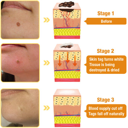 🍉Flysmus™ TagRecede Bee Venom Spray LAST DAY 70% OFF